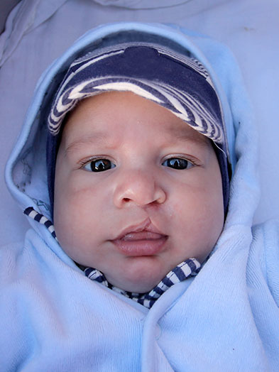 cleft lip and palate