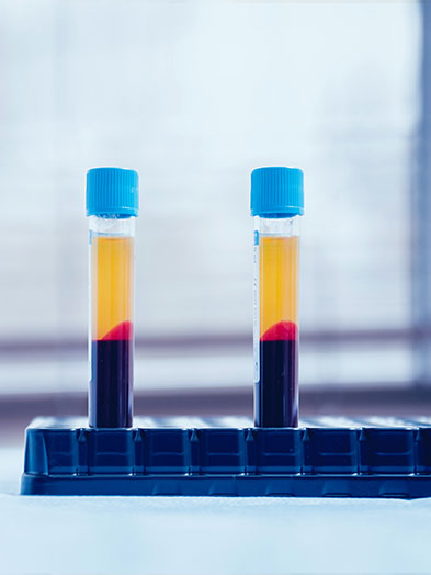 platelet rich fibrin