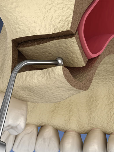 sinus lift