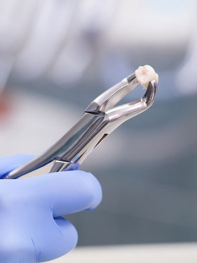 tooth extractions